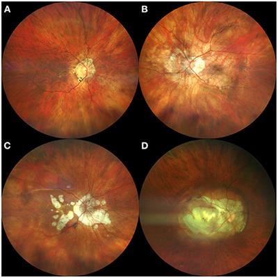 Key Multimodal Fundus Imaging Findings to Recognize Multifocal Choroiditis in Patients With Pathological Myopia